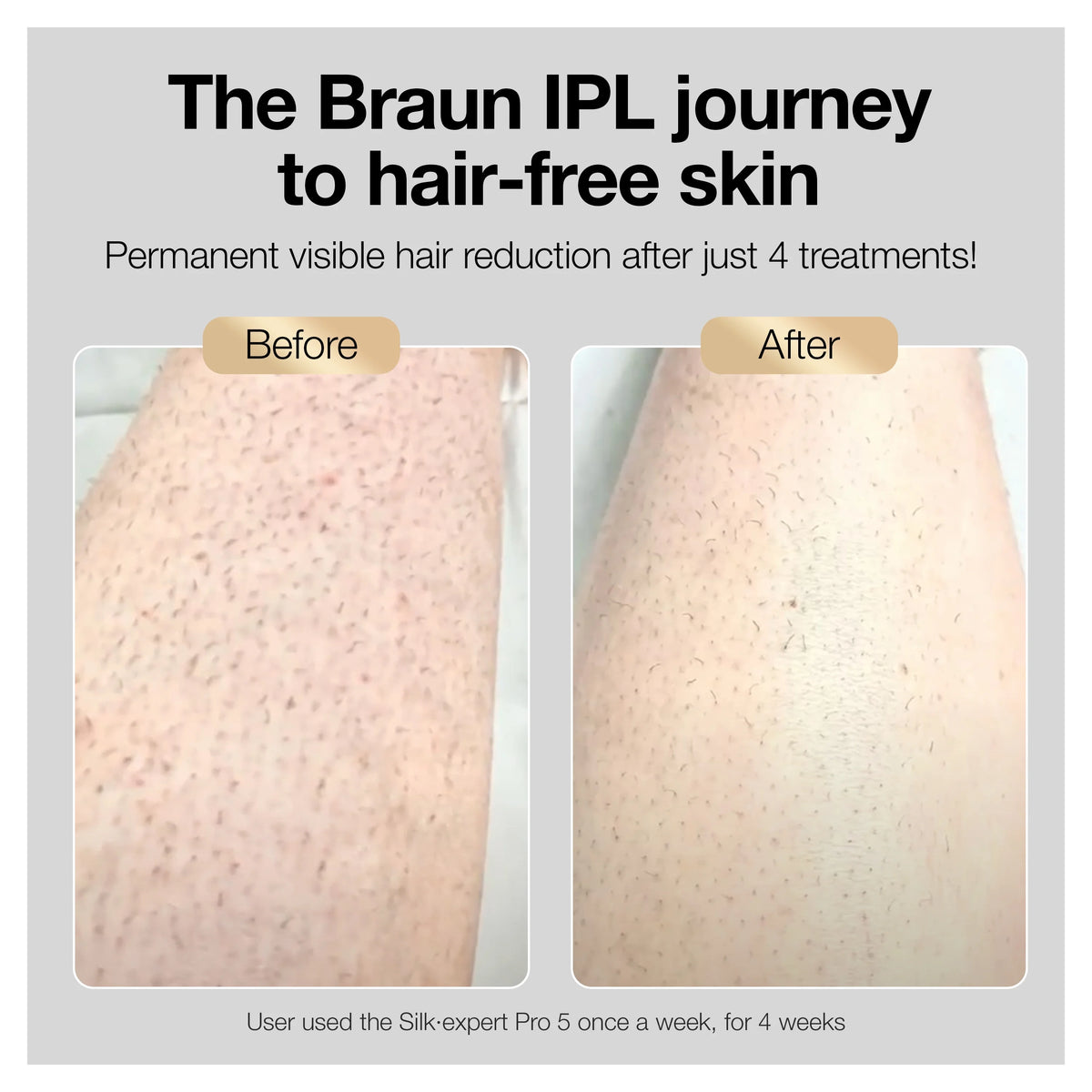 At-Home Hair Removal System A29330